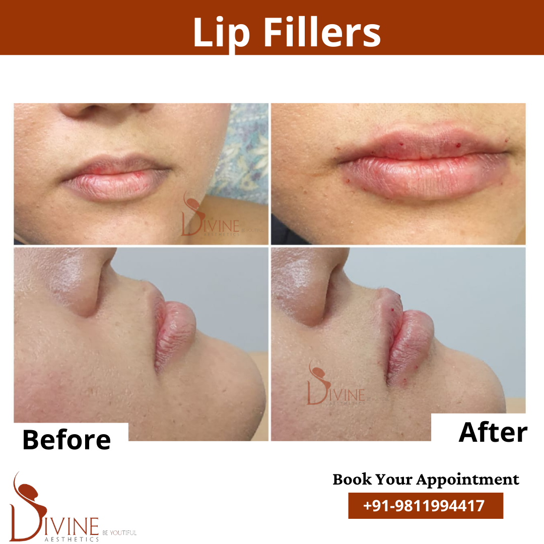 Lip Fillers