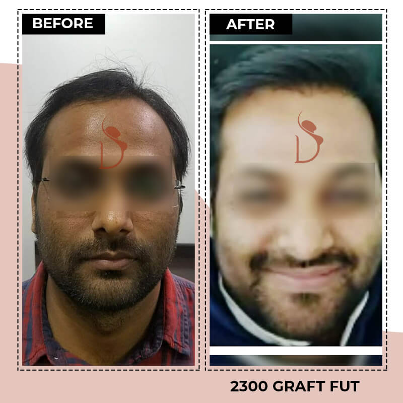 Hair Transplant in Bangalore  Fue in Bangalore  DNA Skin Clinic