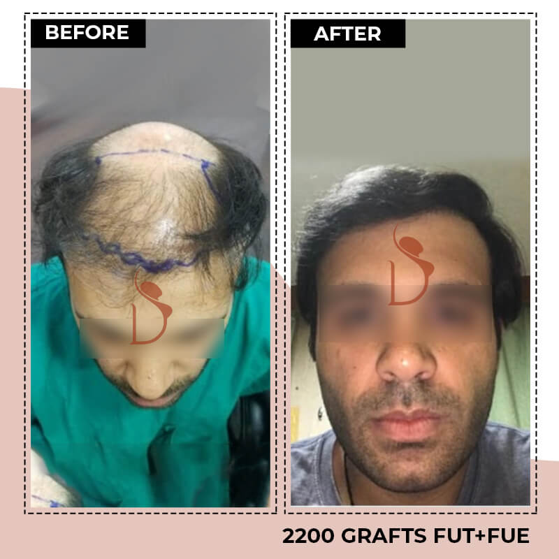 Hair Transplant Surgery in Mangalore Hair Transplant Cost in Mangalore