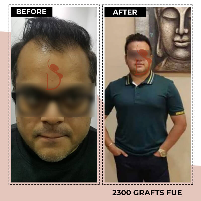Hair Transplant - Surgery Procedure, Type & Side Effects