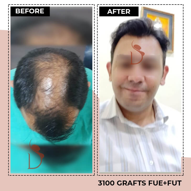 Hair Transplant Before and After - Dr Amit Gupta Plastic Surgeon In Delhi ,  Gurgaon (India)