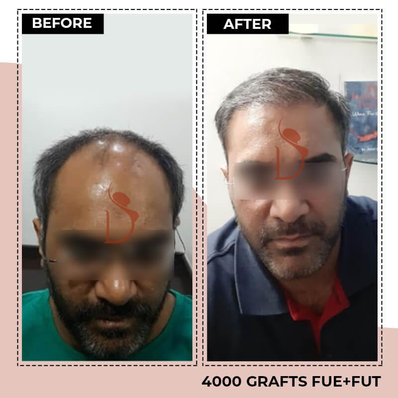 Best Hair Transplant Clinic in Nagpur: View Results & Cost