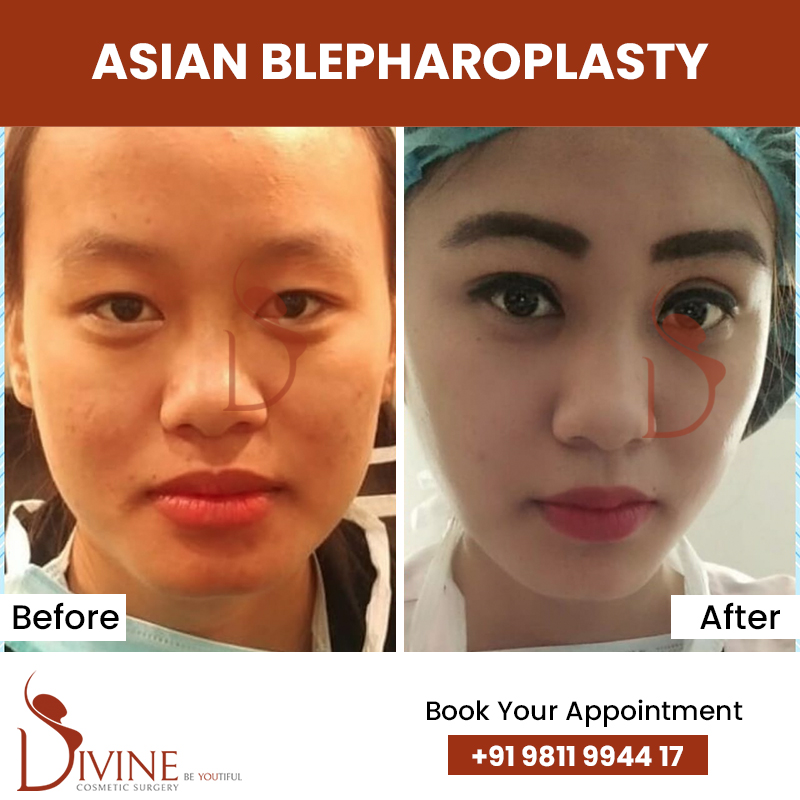 Blepharoplasty Before and After - Dr Amit Gupta Plastic Surgeon In ...