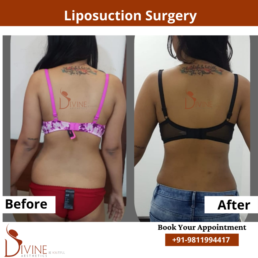 Vaser Liposuction Surgery after before