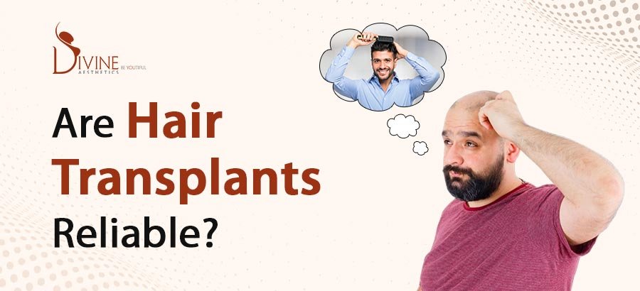 Are Hair Transplants Reliable?