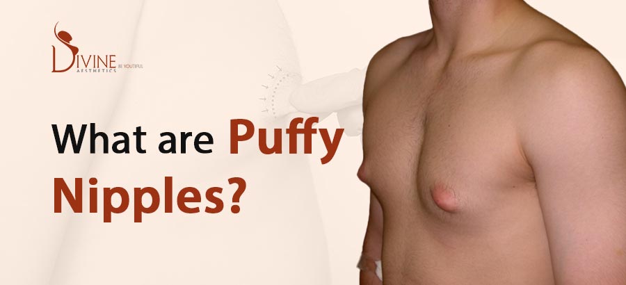 Puffy Nipples - Fat Nipples - Gynecomastia