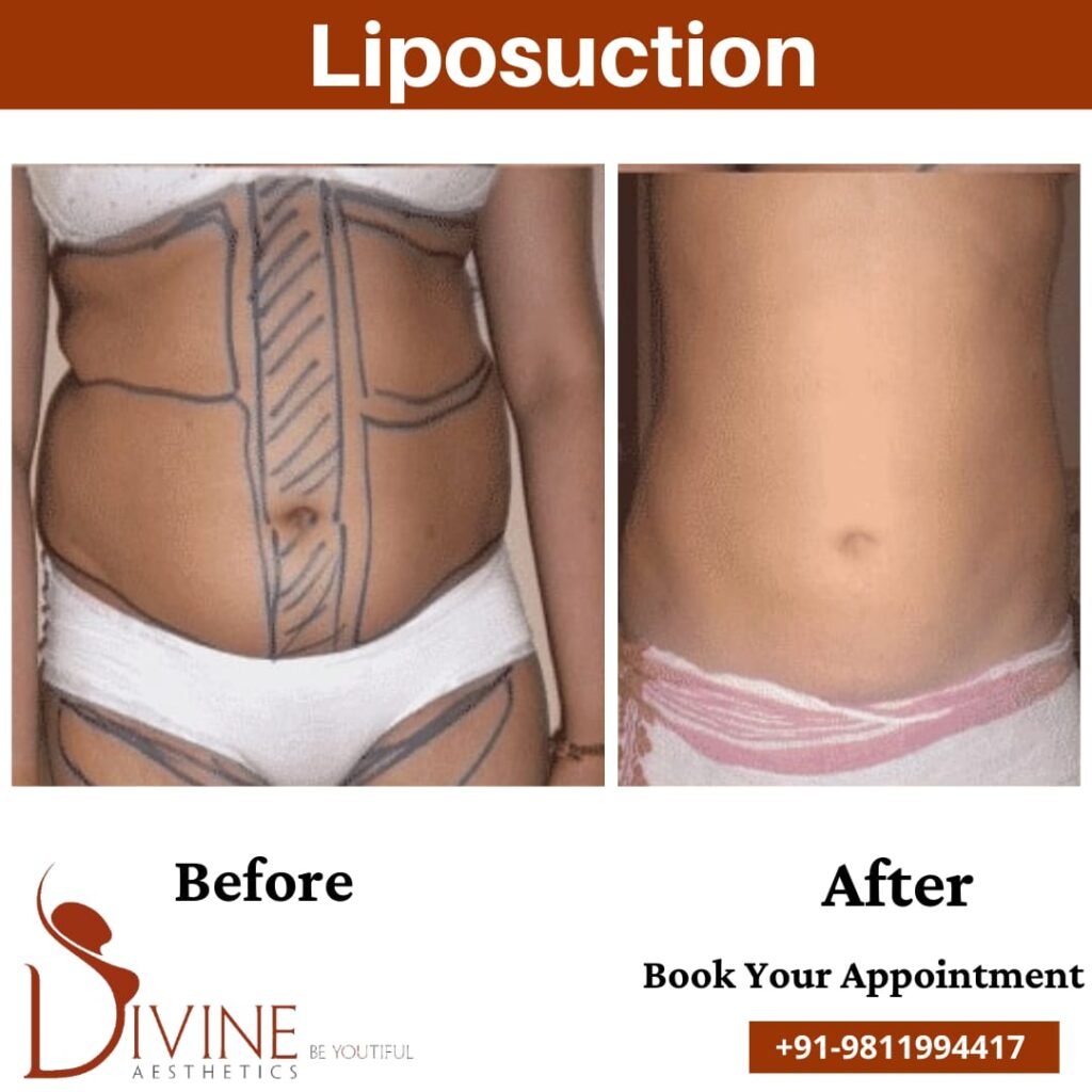 Vaser Liposuction Surgery In Delhi, Gurgaon & India With Less Cost And Time