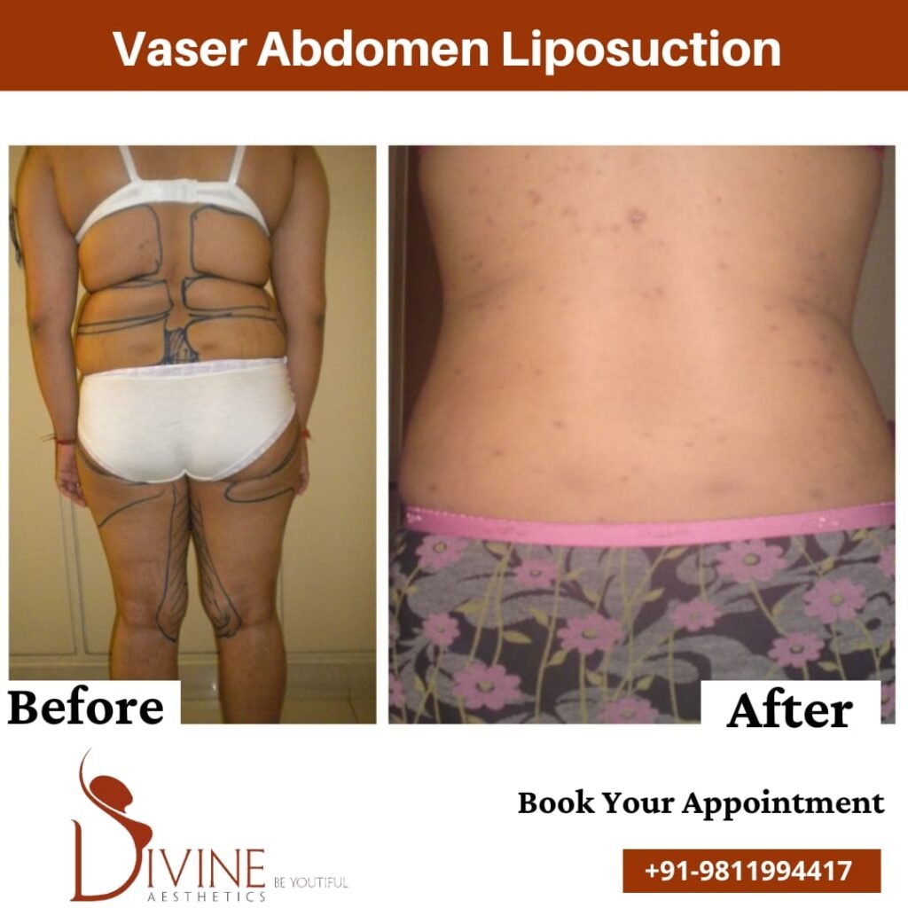 Back Vaser Abdomen liposuction before after surgery done by doctor Amit Gupta