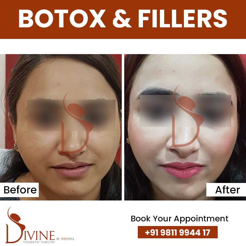 Botox Before After Results