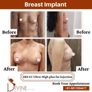 Breast Implants Before and After Pregnancy