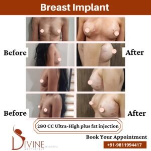 Breast Implants Before and After Pregnancy