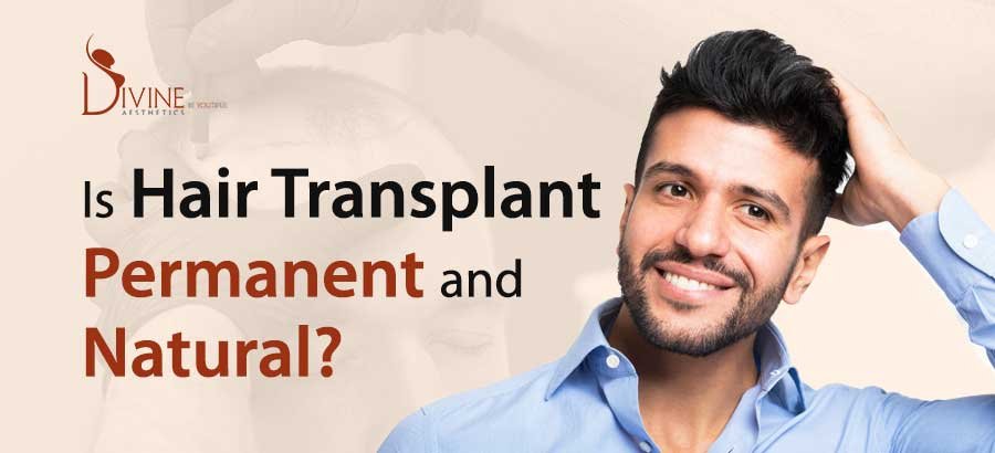 Is Hair Transplant Permanent and Natural?