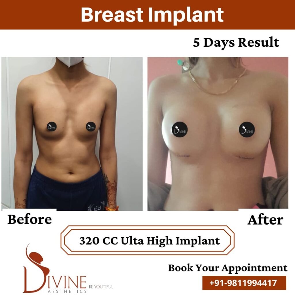 Breast Implant Before After 1 : Breast implant surgery results : after and before in delhi