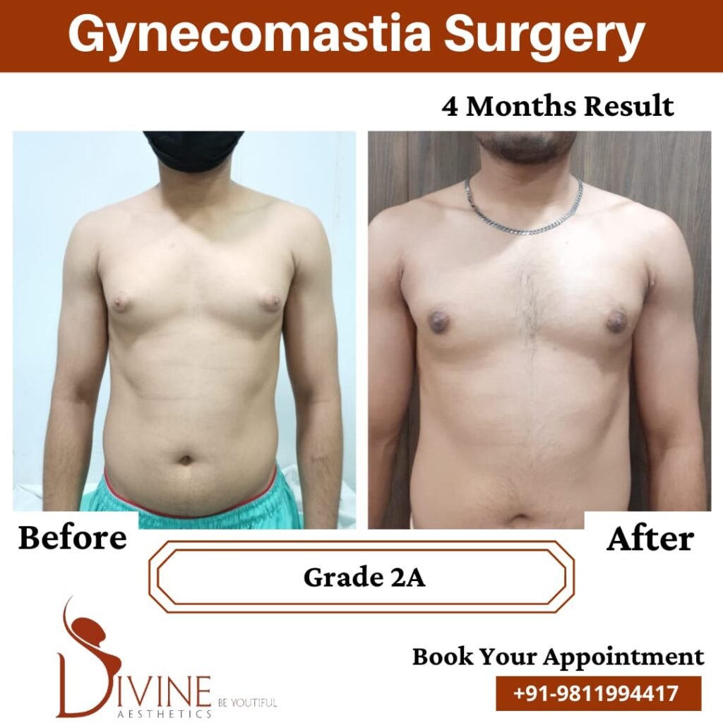 Gynecomastia grade 2 surgery before and after Image