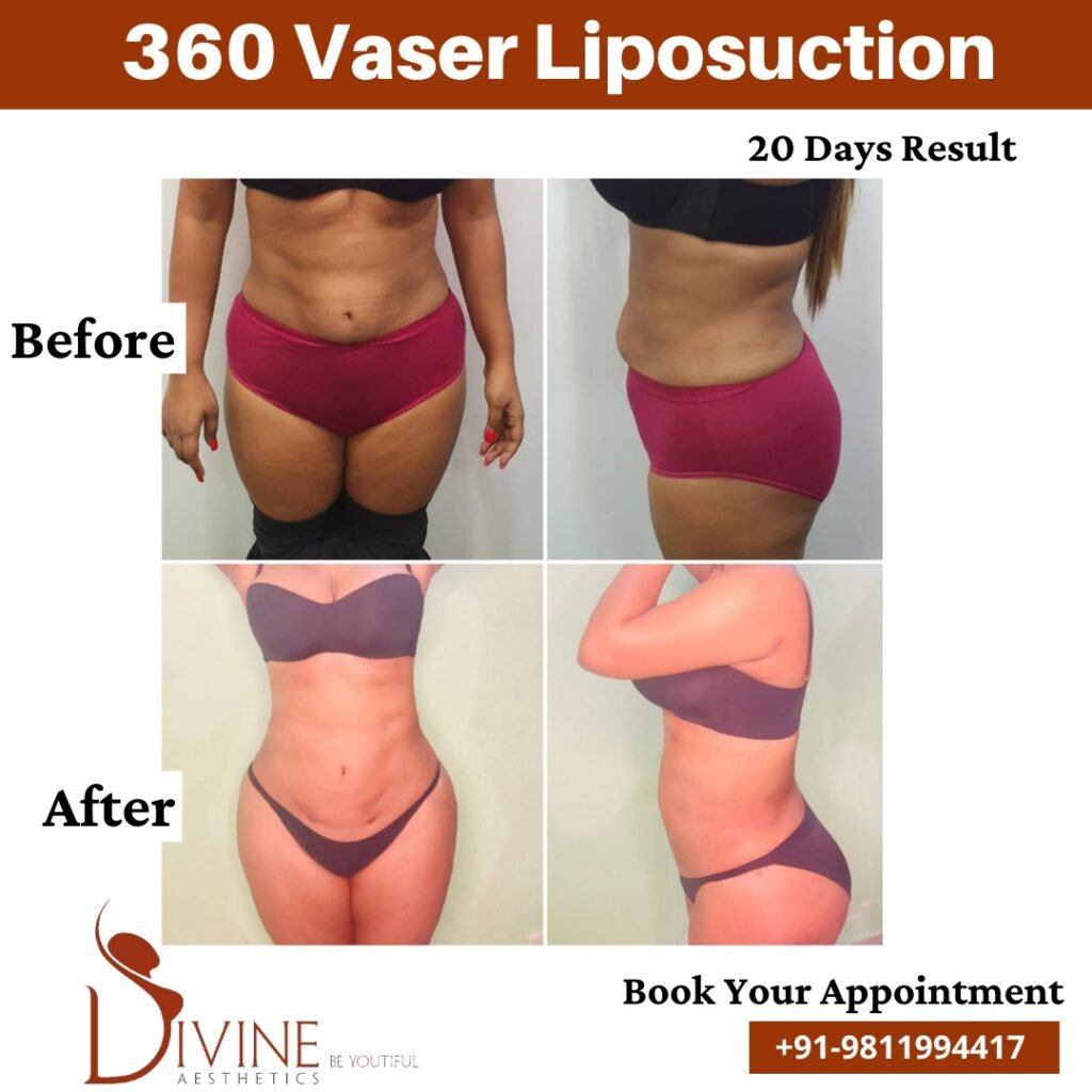 360 Vaser Liposuction before after 1 March 2022