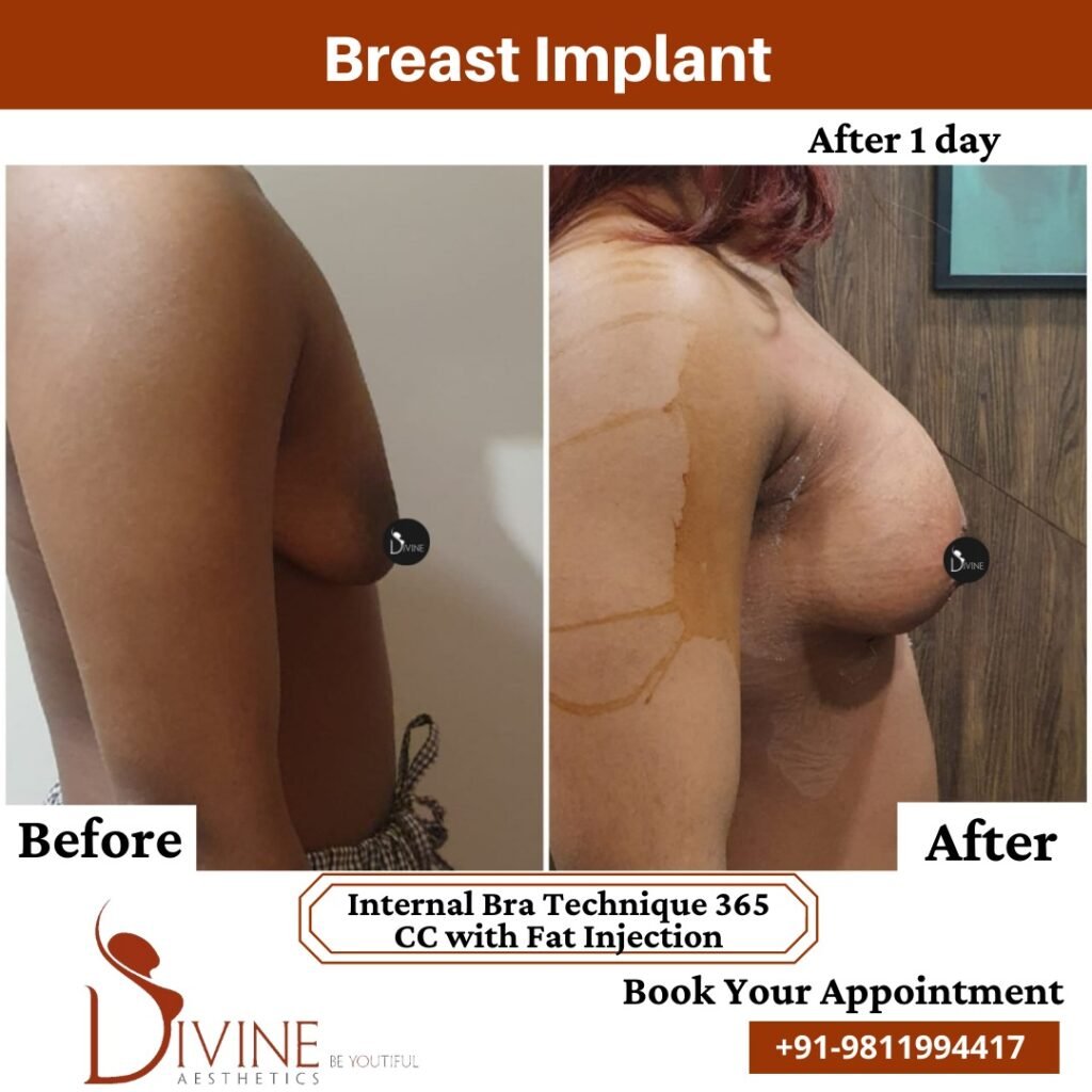 Breast Implant before after 3 March 2022