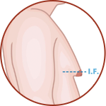 GRADE 3 + SKIN LIFT
