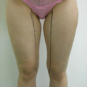 Inner thigh Liposuction