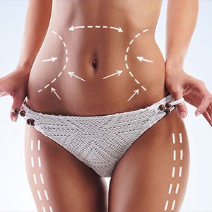 Liposuction