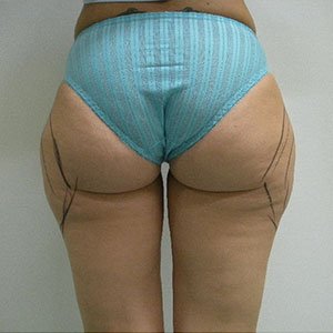 Outer Thigh Liposuction