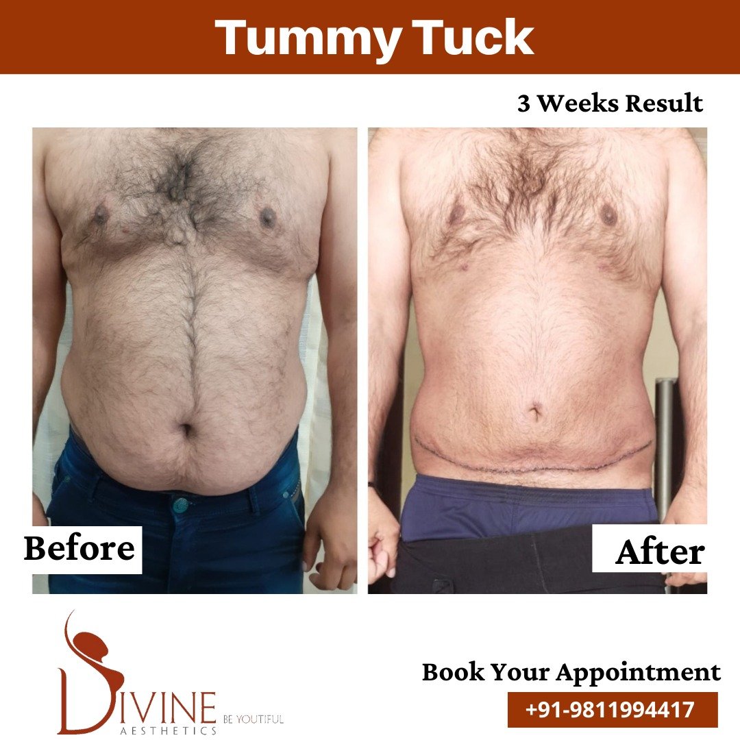 Tummy Tuck before after 2 March 2022