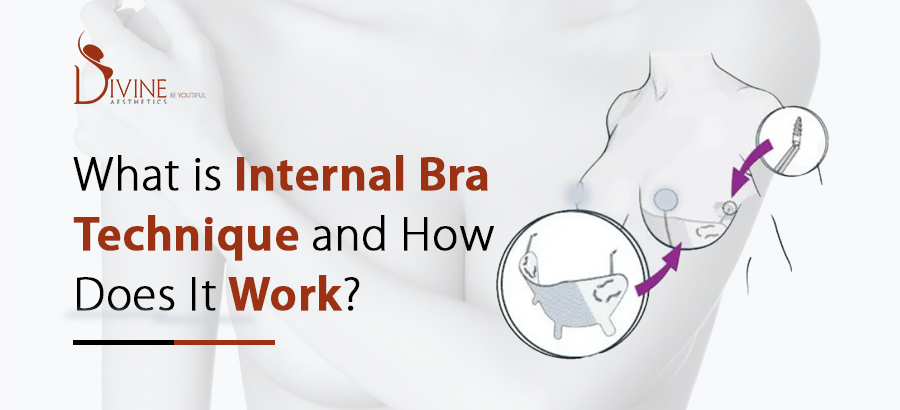 What is an Internal Bra? Sometimes an implant needs more support