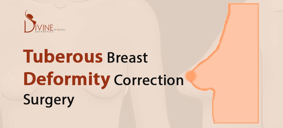 Tuberous Breast Correction  3 Cosmetic Surgery Techniques