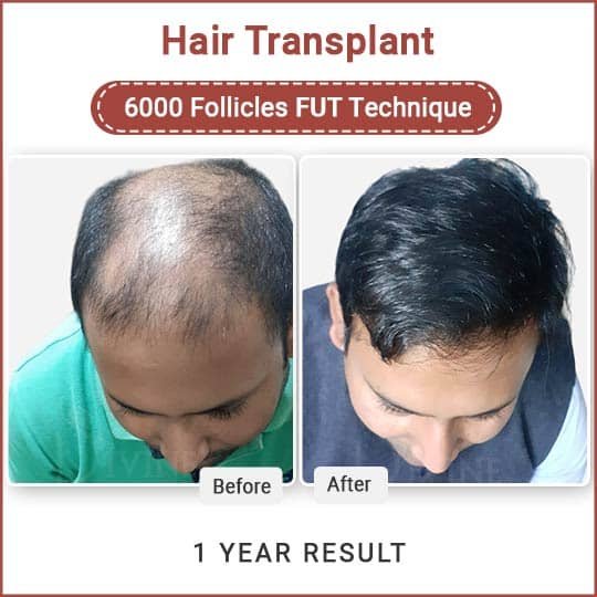 Hair transplant in Delhi