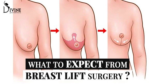 What to Expect from Breast Lift Surgery?