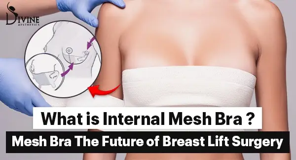 What is an Internal Mesh Bra?